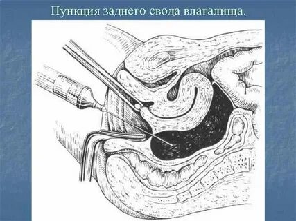 Выделение после пункции