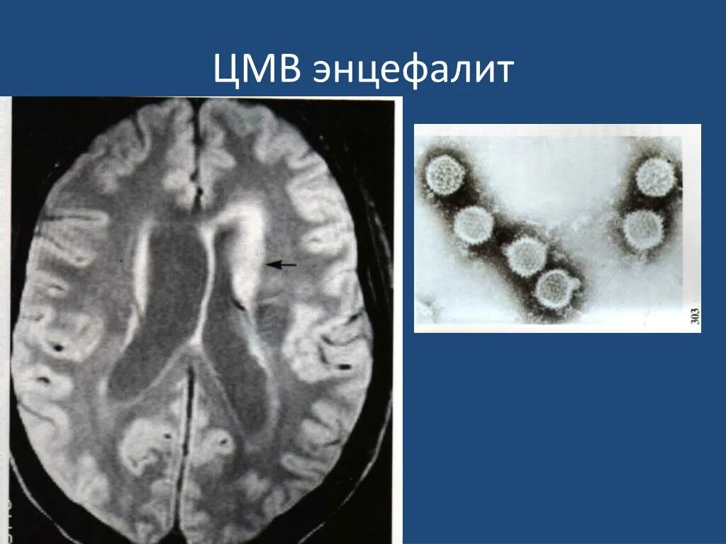 Энцефалит головного мозга у взрослых. Цитомегаловирусный энцефалит ВИЧ. ЦМВ головного мозга мрт. Цитомегаловирусный энцефалит гистология. Цитомегаловирус энцефалиты на мрт.