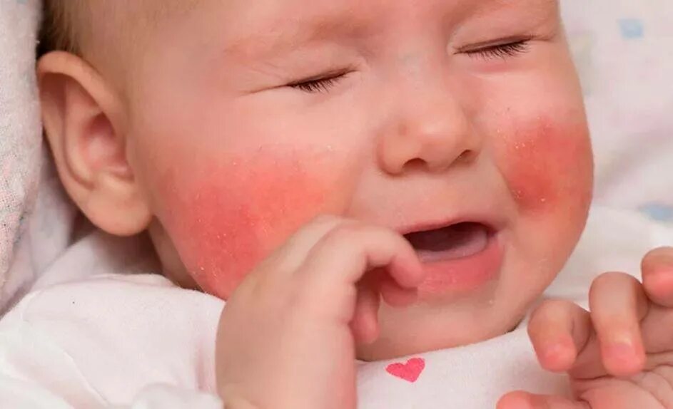 Экссудативно катаральный диатез. Красная сыпь на щеках у грудничка. Красные щеки у грудничка. Красная щека у грудного ребенка. Красная щека у грудного ребенка.
