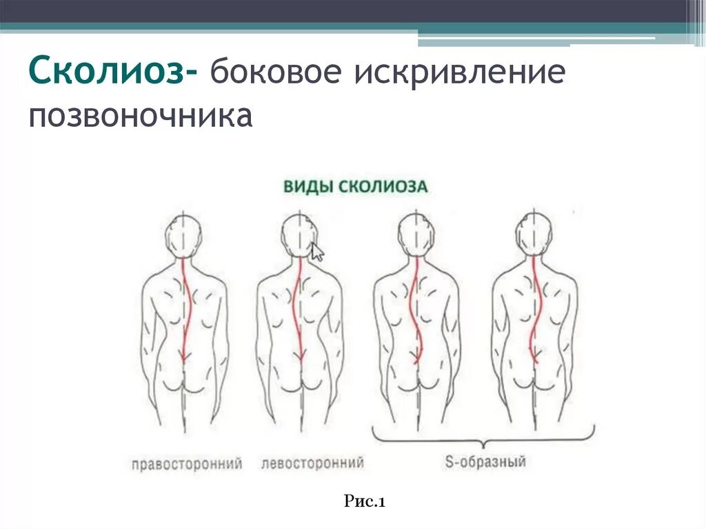 Правосторонний сколиоз вид спереди. W образный сколиоз позвоночника. Сколиоз позвоночника сбоку. Z- образный сколиоз (с тремя дугами искривления);.