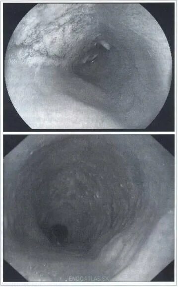 Недостаточность кардии пищевода патогенез. Кардиальный жом желудка. Несмыкание кардии. Несмыкание кардии. Недостаточность пищеводно-кардиального отдела.