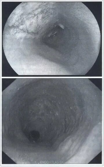 Эндоскопические признаки кардии. Недостаточность кардии ФГДС. Эндоскопическая картина недостаточности кардии.