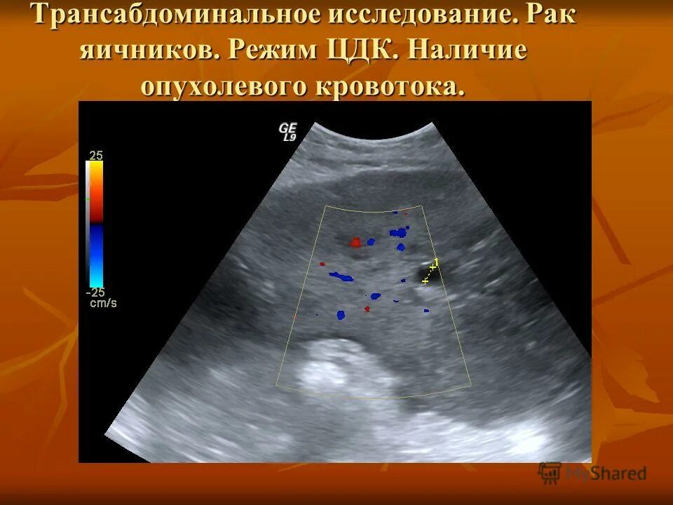 узи принцип метода. васкуляризация щитовидной железы. режим цдк. цдк допплер. режим цдк.