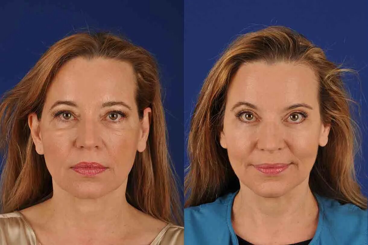 Brow lift. Броулифт. Подтяжка лба и бровей.