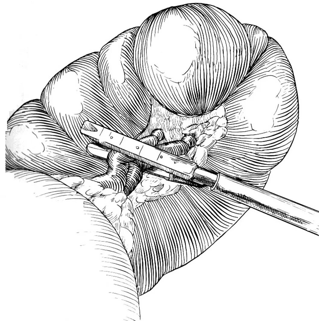 Спленэктомия что это. Лапароскопическая спленэктомия. Лапароскопическая нефрэктомия. Спленэктомия селезенки. Лапароскопическая сигмостомия.