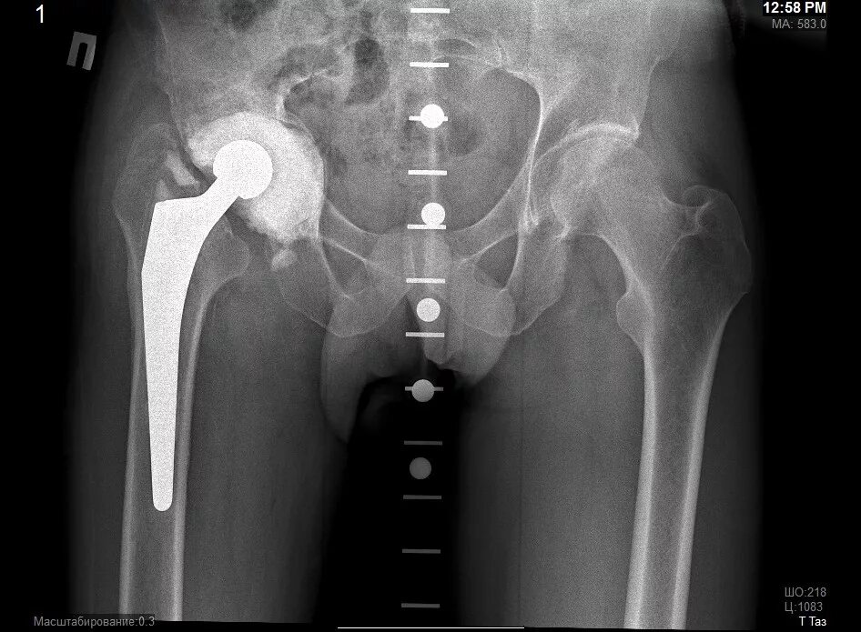Вывих головки эндопротеза тазобедренного сустава. Вывих протеза тазобедренного сустава рентген. Вывих головки эндопротеза тазобедренного сустава рентген. Вывих протеза тазобедренного сустава рентген. Подвывих эндопротеза тазобедренного.