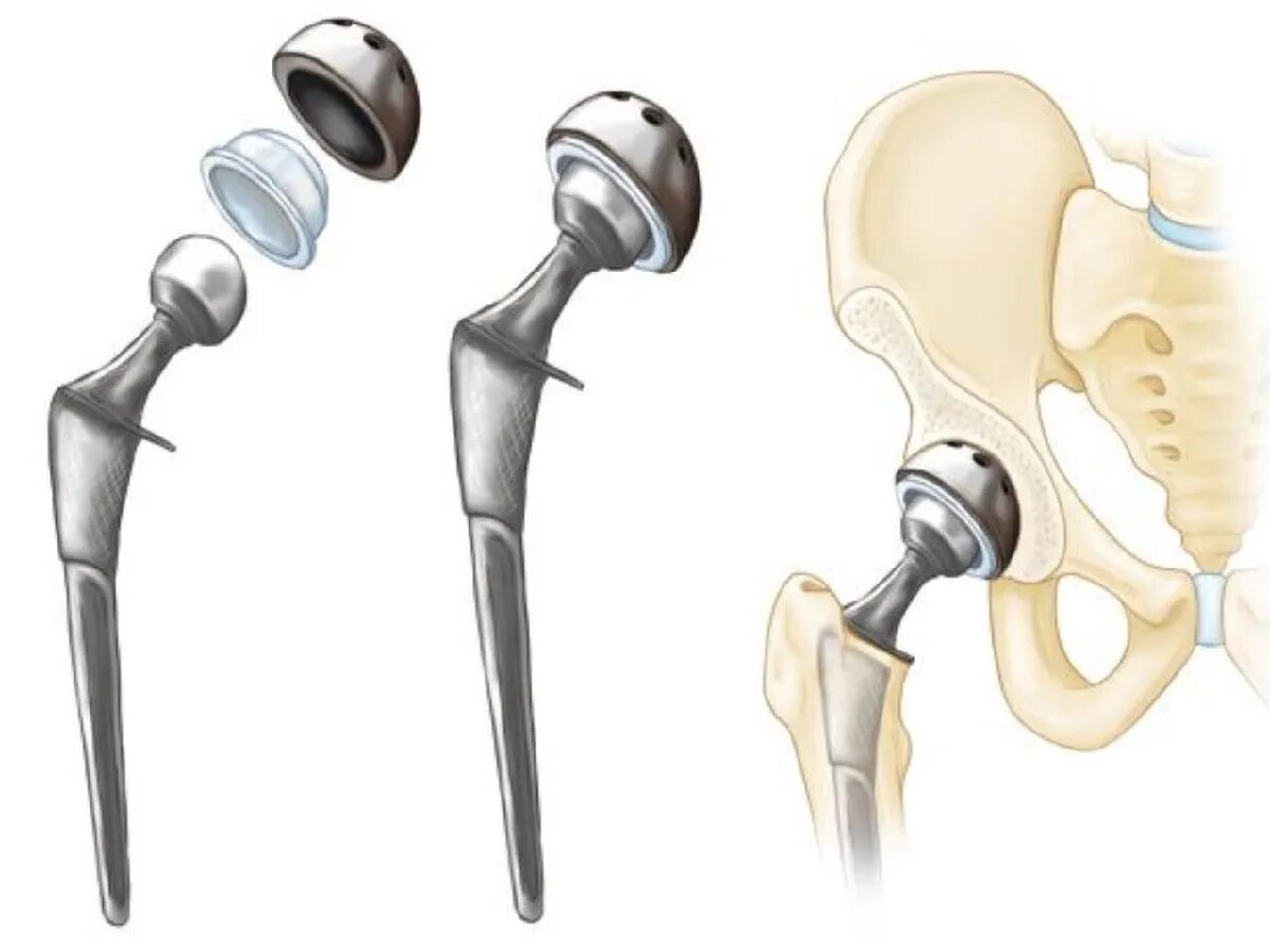 Операция по замене тазобедренного как происходит. Перелом шейки бедра эндопротезирование тазобедренного сустава. Керамический эндопротез тазобедренного сустава. Ревизионное эндопротезирование тазобедренного сустава. Эндопротез тазобедренного сустава.
