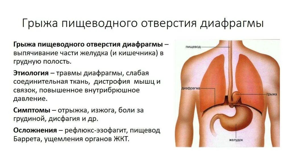 Грыжа пищеводного отверстия диафрагмы клиника. Грыжа диафрагмального отверстия симптомы. Диафрагмальная грыжа пищеводного отверстия диафрагмы симптомы. Грыжа пищевого отверстия диафрагмы диагностика. Грыжа пищеводного отверстия симптомы лечение