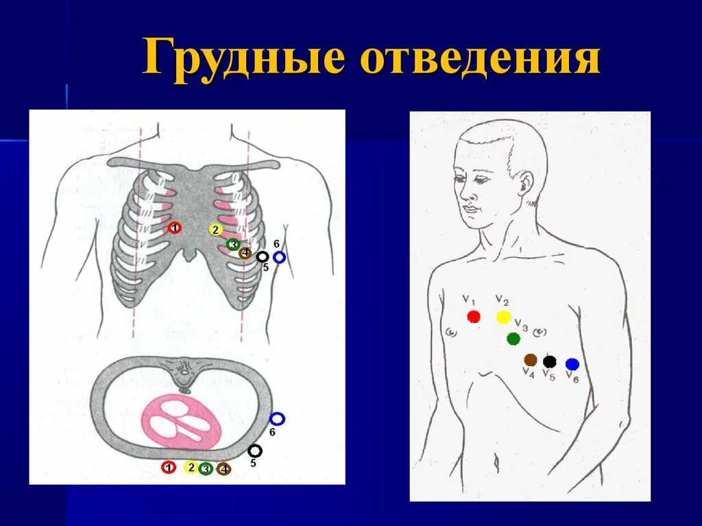 Правые и левые грудные отведения на экг. Левые грудные отведения. Грудные отведения. Левые грудные отведения. Левые грудные отведения.