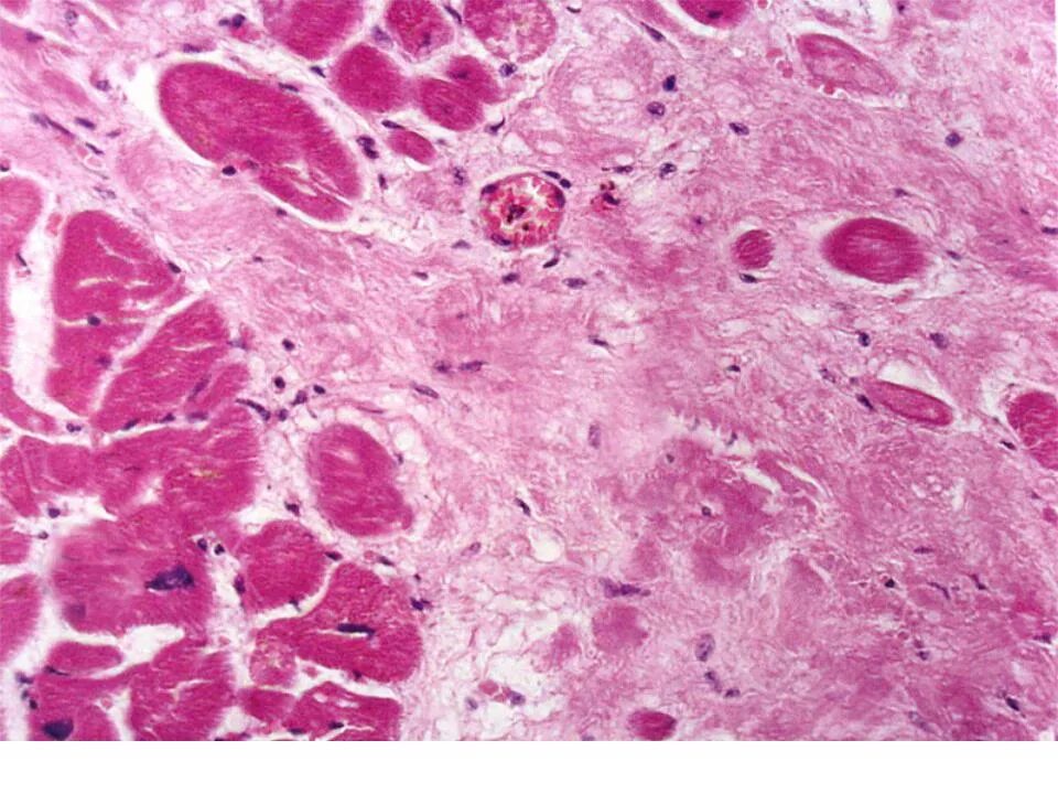 Диффузный мелкоочаговый. Диффузный мелкоочаговый кардиосклероз гистология. Мелкоочаговый кардиосклероз гистология. Крупноочаговый постинфарктный кардиосклероз патанатомия. Диффузный мелкоочаговый кардиосклероз патанатомия.
