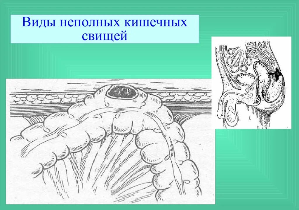 Кишечный свищ. Несформированный кишечный свищ. трубчатый кишечный свищ.