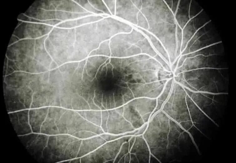 Дистрофия сетчатки Лебера. Оптическая нейропатия Лебера. Ангиоидные полосы сетчатки.
