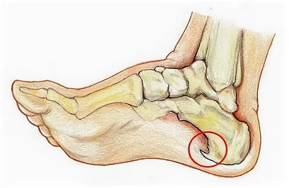 Остеофит пяточной кости. Остроконечный остеофит пяточной кости. Отложение в пятке