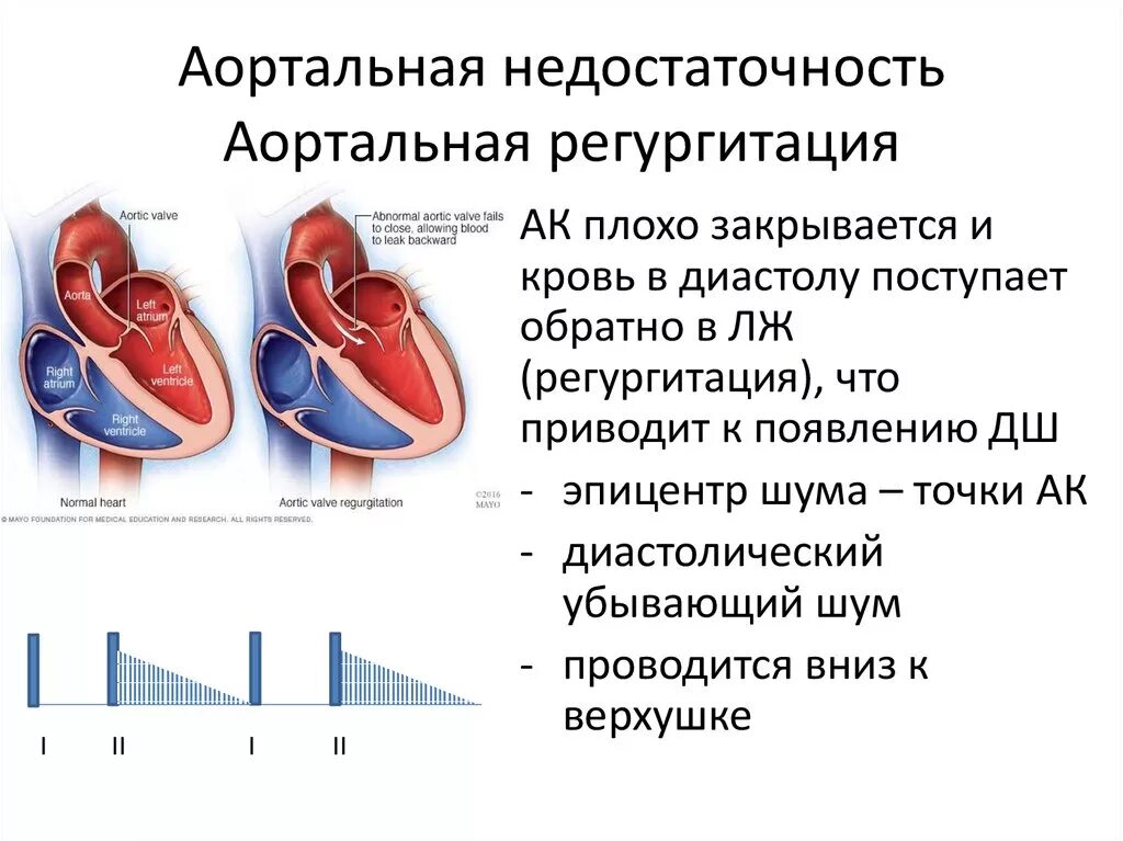 Недостаточность клапана 1 степени