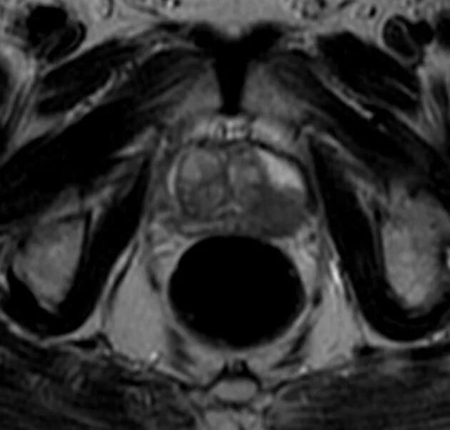 Предстательная железа на томограмме. Гиперплазия предстательной железы мрт. Аденома предстательной железы мрт. Карцинома мрт предстательной железы. Аденома простаты мрт