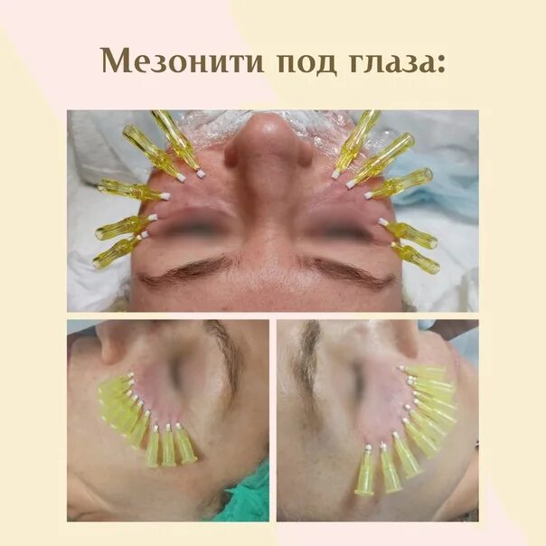 Мезонити под глазами фото Мезонити для подтяжки лица: отзывы. до и после мезонитей: фото