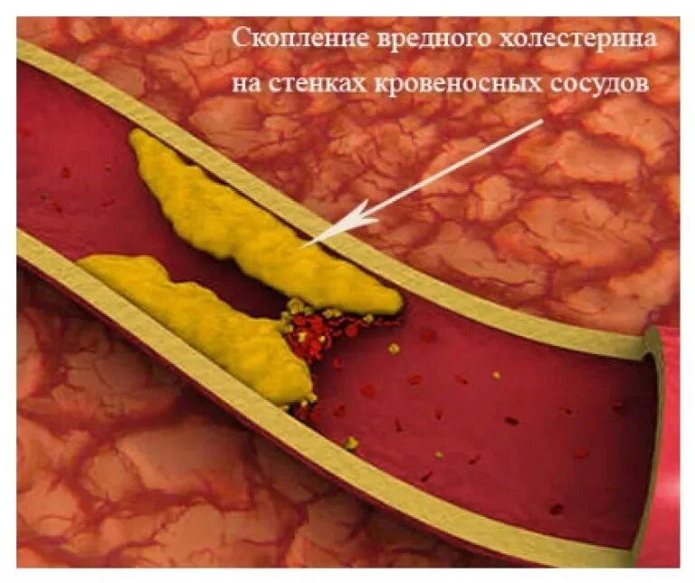 Холестерин. Вредный холестерин. Повышенный уровень холестерина.