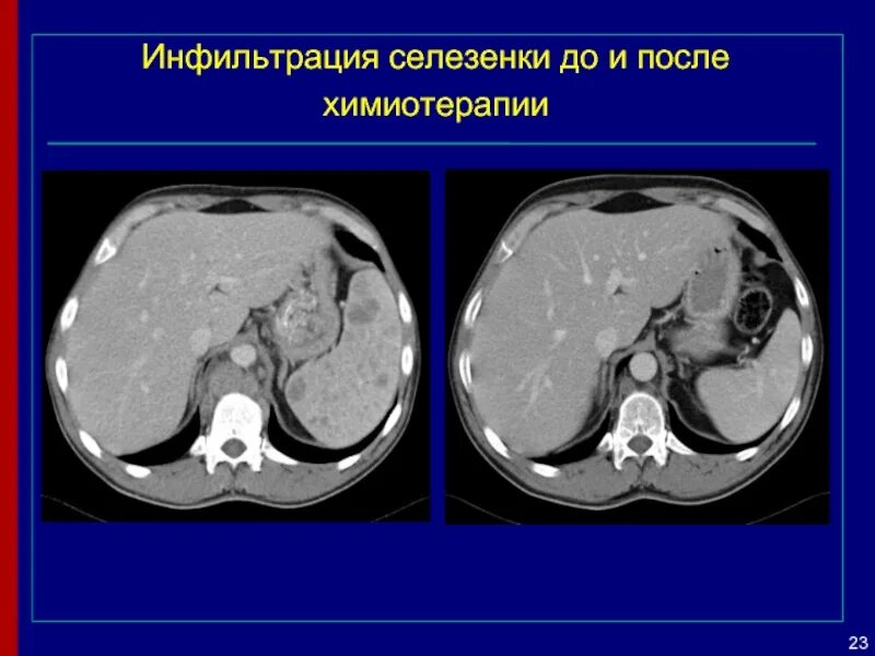 Кт после химиотерапии. Лимфома Ходжкина кт селезенка. Гемангиома селезенки кт.