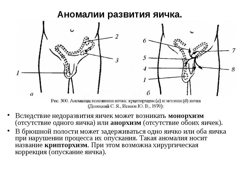 Неопущение яичек (крипторхизм). Анорхизм отсутствие яичек. Односторонний крипторхизм. Яички в брюшную полость