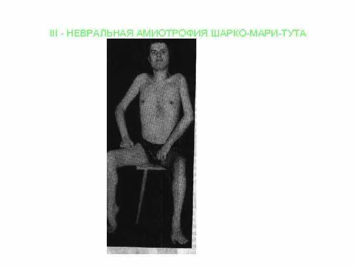 Невральная амиотрофия шарко. Невральная мышечная атрофия Шарко-Мари. Синдром Шарко Мари Тутта. Дистрофия Шарко Мари тута.