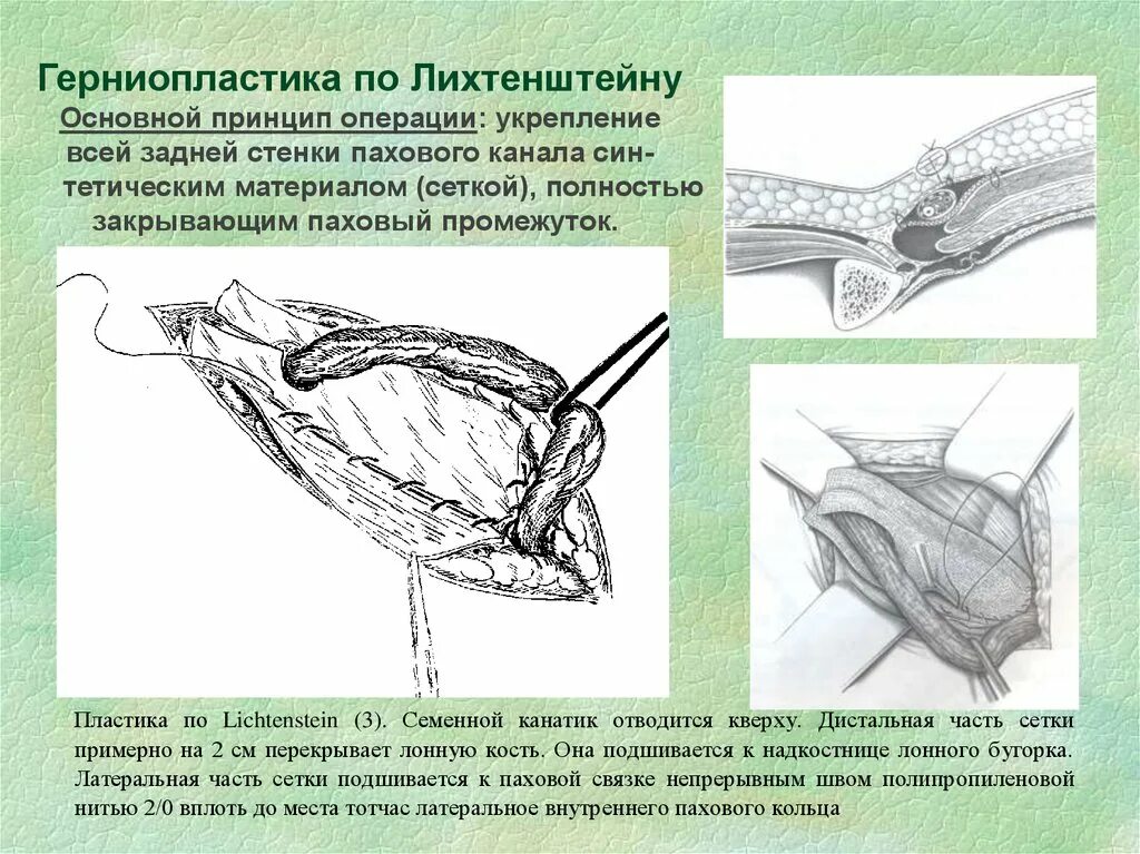 Грыжесечение аллопластика по Лихтенштейну. Паховая грыжа лапароскопически. Пластика по Лихтенштейну полипропиленовой сеткой. Герниопластика по Лихтенштейну ход операции. Лихтенштейн операция паховая