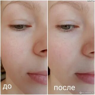 Тональные при куперозе