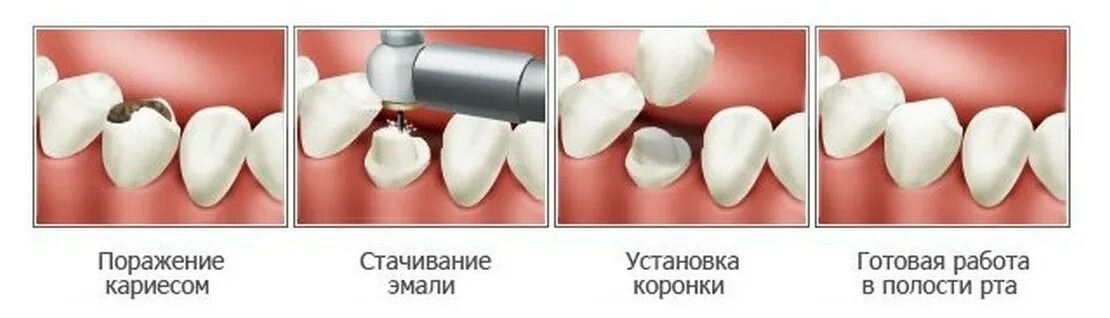 Металлокомпозитная коронка препарирование. Этапы установления коронки на зуб. Штифтовая вкладка коронка. Как ставится коронка на зуб.