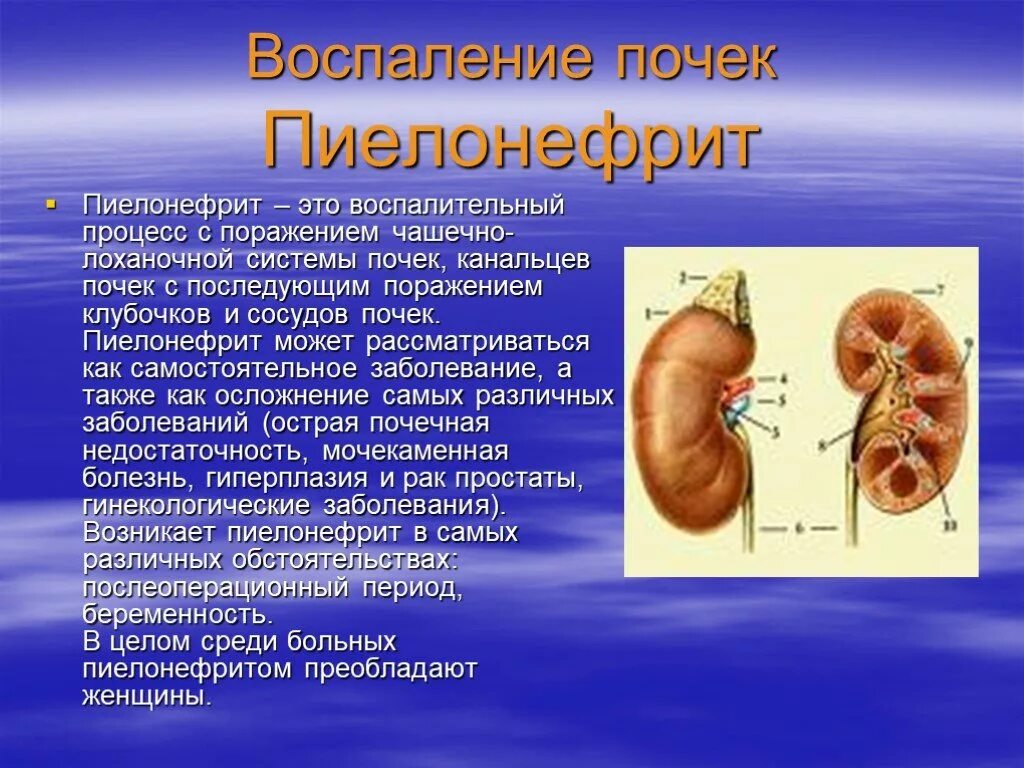 Симптомы поражения почек. Заболевание почек пиелонефрит. Инфекция в почках пиелонефрит. Патология почки. Пиелонефрит. Хроническая болезнь почек пиелонефрит.