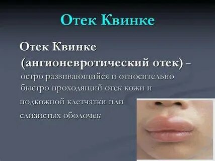 Снятие отеков горла