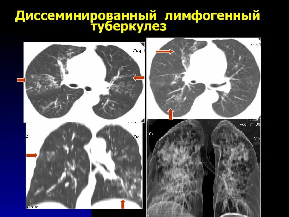 Лимфогенный туберкулез. Подострый диссеминированный туберкулез кт. Диссеминированный инфильтративный туберкулез. Диссеминированный туберкулез легких на кт. Лимфогенный диссеминированный туберкулез рентген.