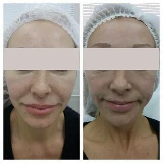 Эффект плазмолифтинга отзывы
