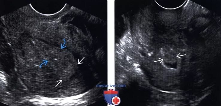 Аденокарцинома эндометрия УЗИ. Карцинома эндометрия матки УЗИ. Аденокарцинома матки УЗИ. Не видна матка на узи