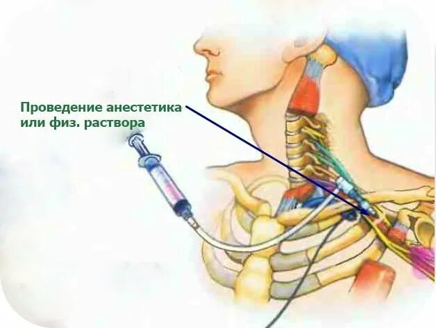 Блокада сплетения. Блокада плечевого сплетения. Блокада плечевого сплетения по Куленкампфу. Проводниковая анестезия плечевого сплетения. Проводниковая блокада плечевого сплетения.