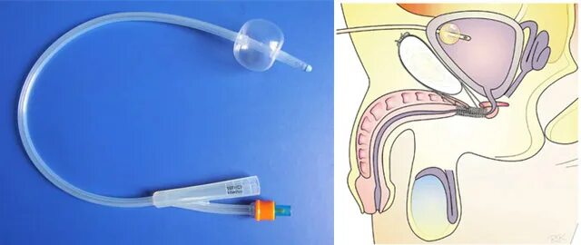 Трубочку в мочевой пузырь