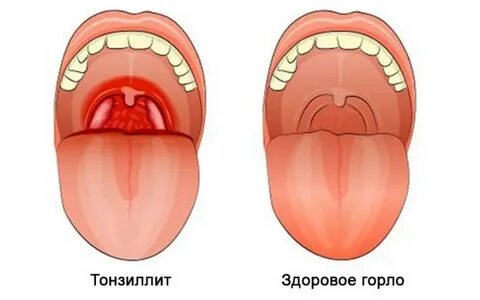 Чем лечить красное горло ребенку 4 года