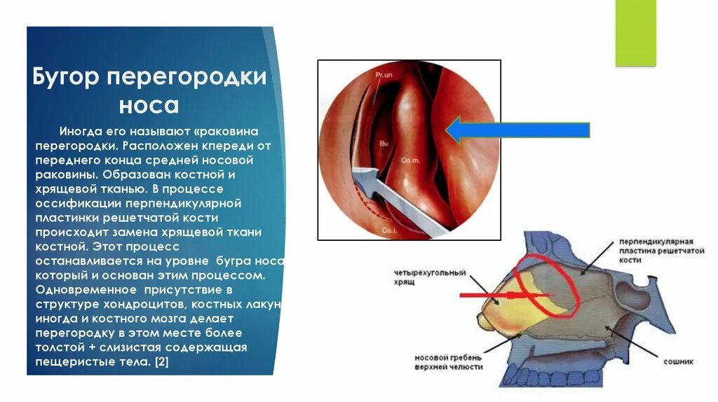 Удаление гребня. Костный гребень носовой перегородки. Шип и гребень носовой перегородки. Носовая перегородка строение. Образование костного гребня в носу.