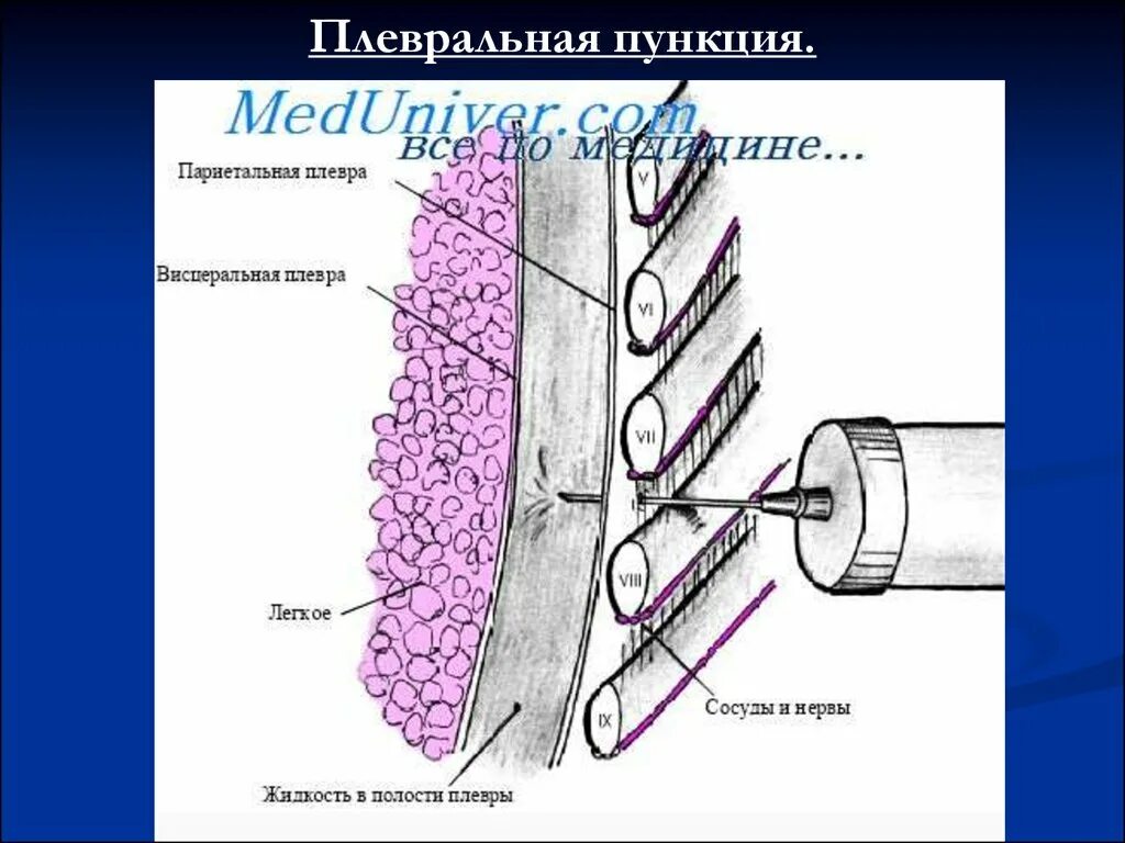 Пункция экссудата. Методика пункции плевральной полости. плевральная пункция схема. плевральная пункция (торакоцентез).