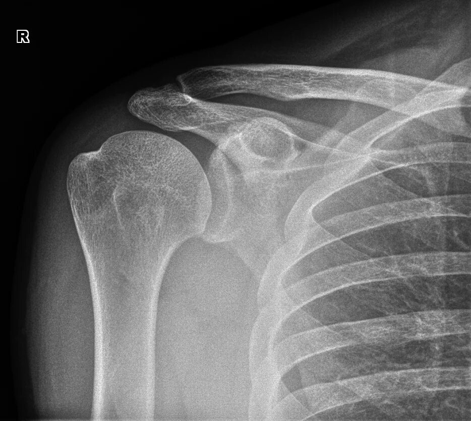 Рентгеновский снимок плечевого сустава норма. Плечевой сустав рентген норма. Рентгенограмма плечевого сустава норма. Нормальная рентгенограмма плечевого сустава.