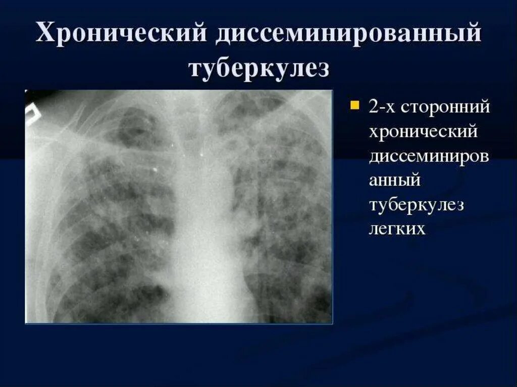 Лимфогенный туберкулез. Хронический диссеминированный туберкулез рентген. Диссеминированный туберкулез легких рентгенограмма. Острый диссеминированный туберкулез легких рентген. Диссеминированный туберкулезентген.