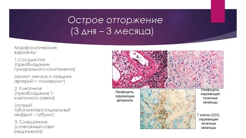 Отторжение функционального слоя. Острое клеточное отторжение в баллах. некротический ангиит кожи.