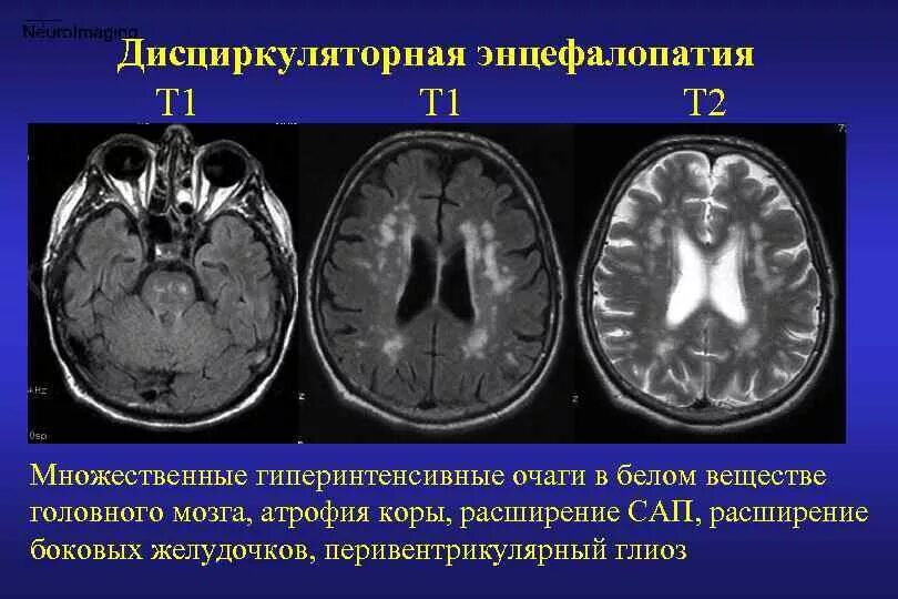 Резидуальные очаги головного мозга. Дисциркуляторная энцефалопатия мрт. Дисциркуляторная энцефалопатия мрт картина. Посттравматическая энцефалопатия головного мозга на мрт. Дисметаболическая энцефалопатия мрт.