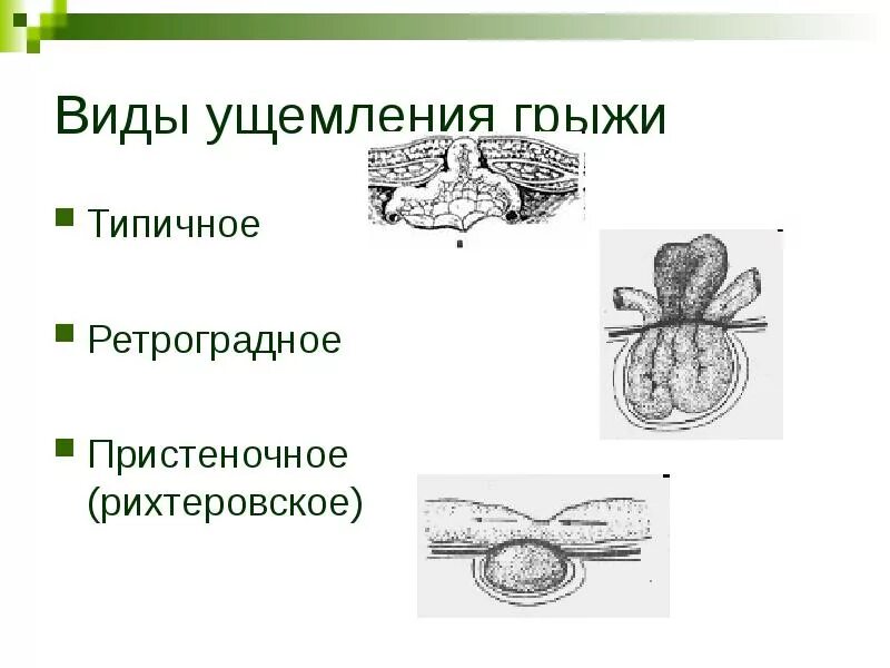 Ответы ущемленная грыжа. Рихтеровское ущемление. Ретроградная ущемленная грыжа.