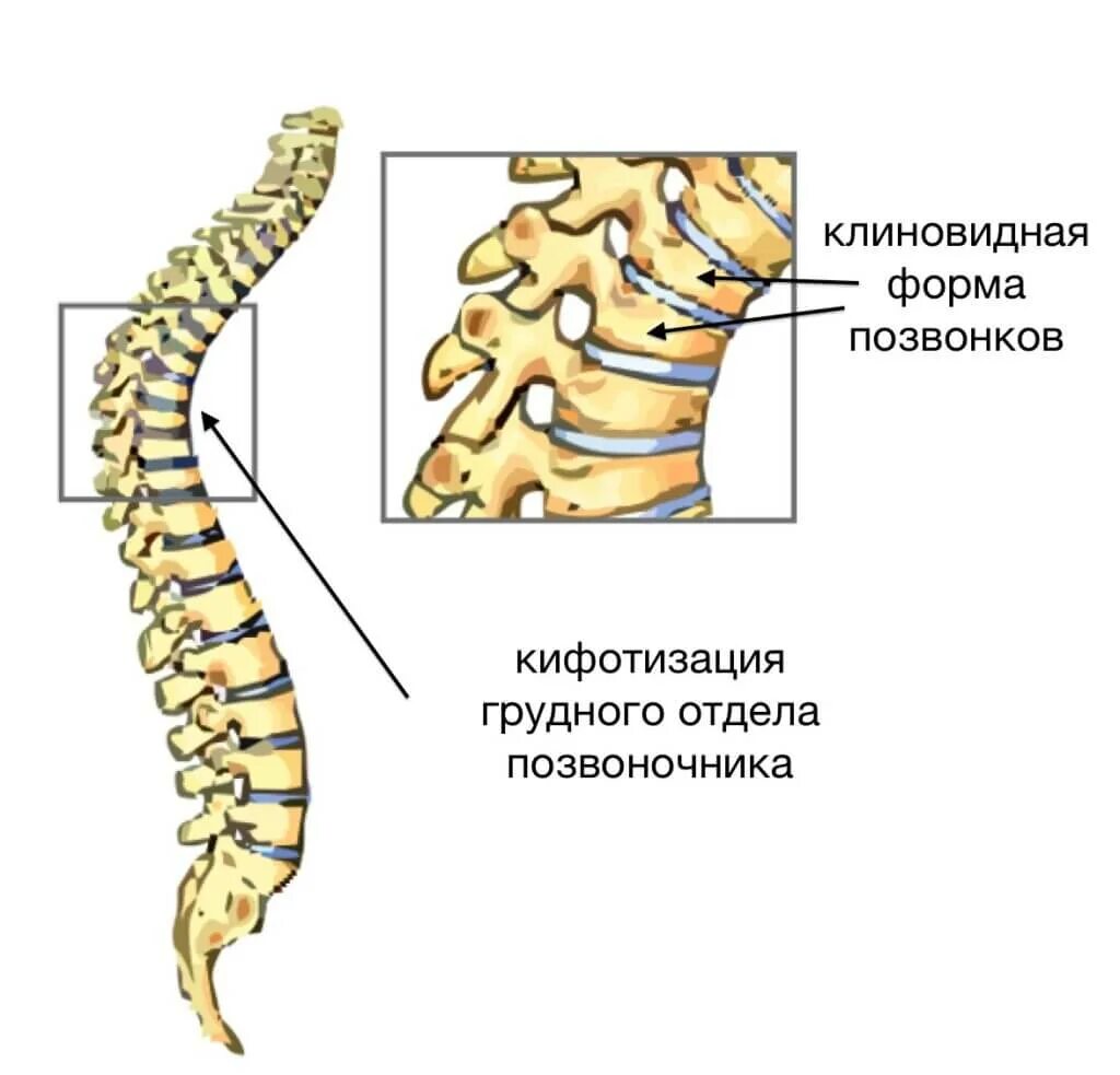 Клиновидная деформация th7 позвонка. Болезнь Шейермана МАУ поясничного отдела. Клиновидная деформация тела th9.