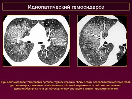 Пневматизация легких снижена