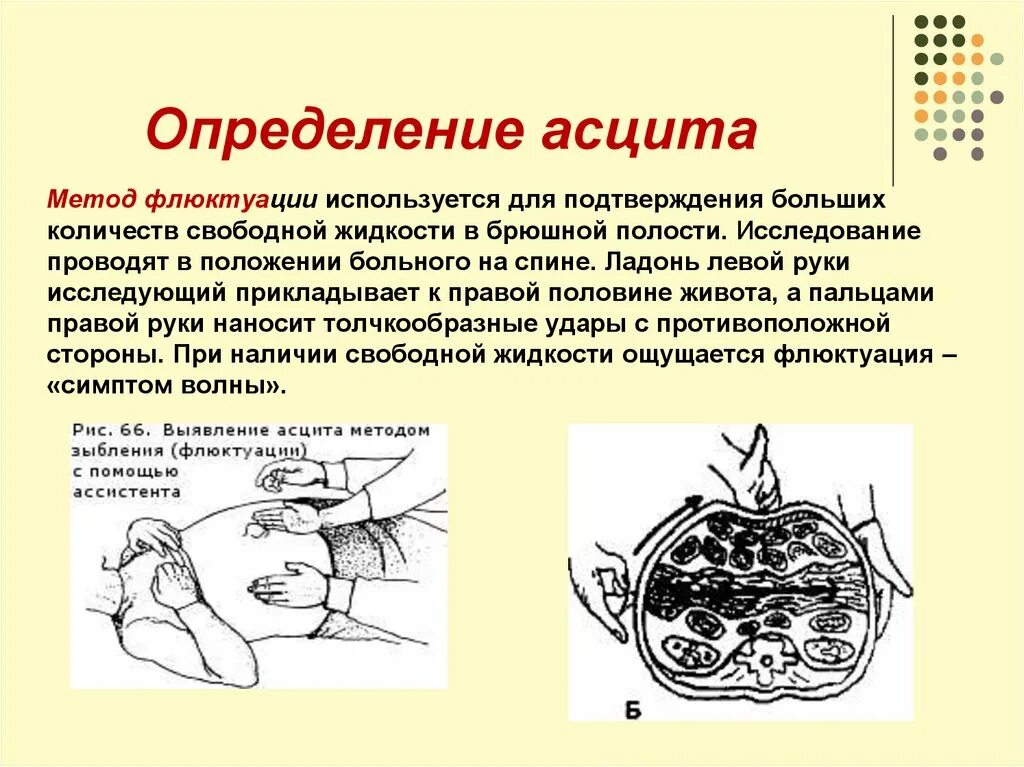 Асцит метод флюктуации. Метод флюктуации при асците. Метод определения асцита пропедевтика.