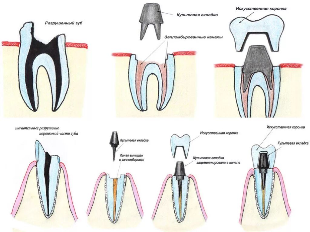 Препарирование корневого канала. Культевая вкладка штифт зуб. Штифтово культевая вкладка в зубе. Культевая Штифтовая конструкция. Культевая вкладка и коронка схема.
