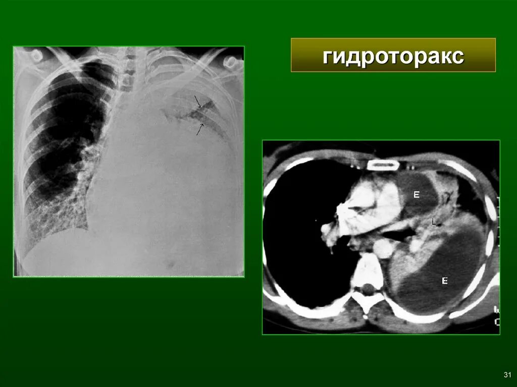 Эмпиема легкого. Тотальный гидроторакс рентген. Хроническая эмпиема плевры кт. Осумкованный гидроторакс. Осумкованный гидроторакс кт.