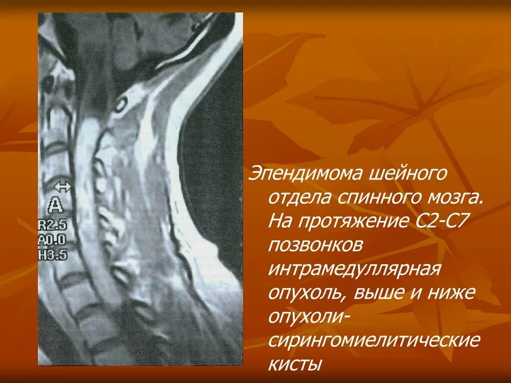 Интрамедуллярная опухоль шейного отдела клиника. Опухоль спинного мозга эпендимома. Интрамедуллярная опухоль спинного мозга клиника. Интрамедуллярная опухоль спинного мозга мрт. Интрамедуллярные опухоли спинного