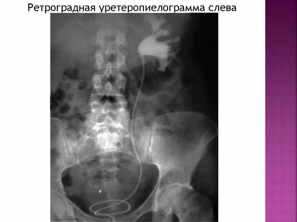 Рентген мочеточника. Экскреторная и ретроградная урография. Экскреторная пиелография. Ретроградная пиелография пиелонефрит. Экскреторная урография и ретроградная пиелография.