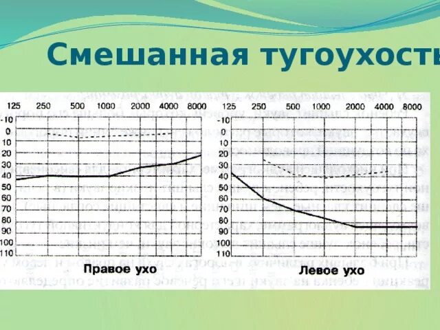 Тугоухость ввк. Смешанная тугоухость 3 степени аудиограмма. смешанная тугоухость тип аудиометрии.